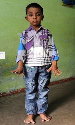 印度4歲男童患病長13根手指和12個(gè)腳趾(圖)
