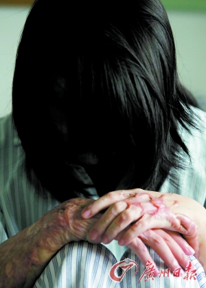 21歲女孩被前男友潑硫酸 選擇堅(jiān)強(qiáng)重新來(lái)過(guò)(圖)