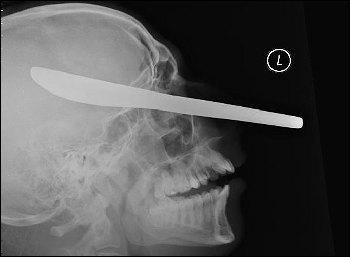 英國小伙頭插餐刀大難不死 驚悚X光片嚇壞法官