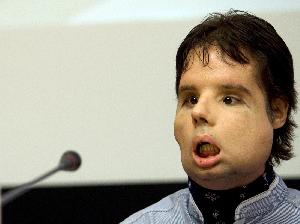 全球首例全臉移植患者亮相 面部功能可恢復九成