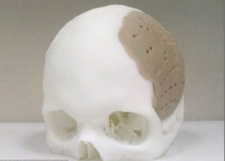 美國(guó)公司用3D打印技術(shù)為病人移植頭骨