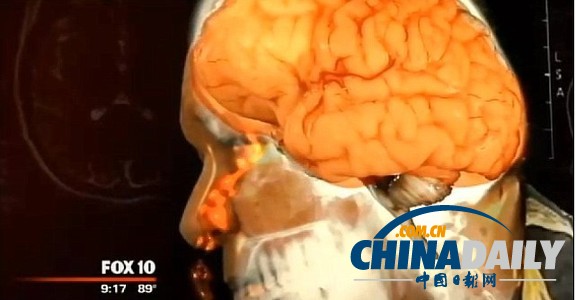 美國(guó)男子一年半鼻涕不停 竟是腦膜破洞漏腦液