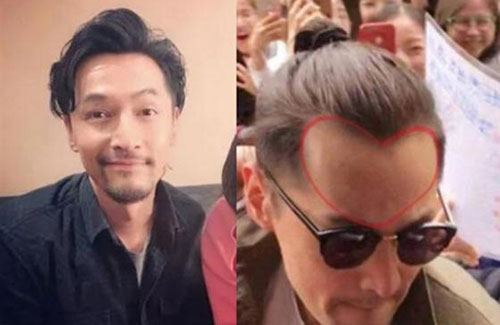 為什么男性禿頭都禿成一個(gè)樣？心疼男神們的發(fā)際線
